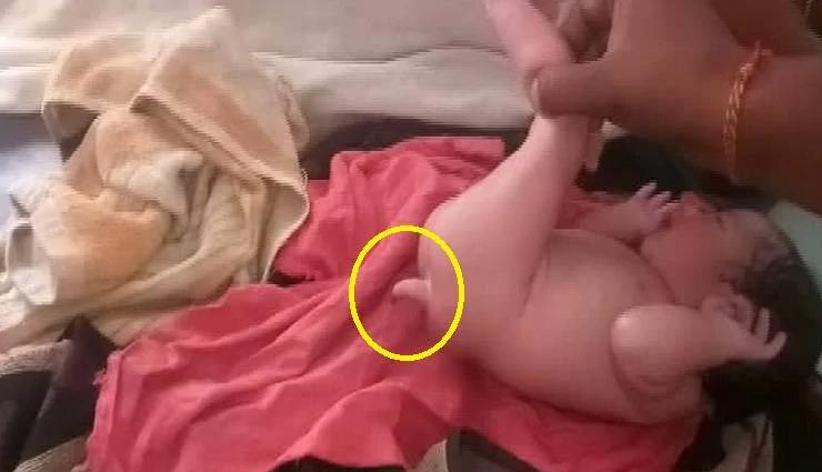 'पूंछ' वाले बच्चे को देखने के लिए अस्पताल में उमड़ा जन सैलाब