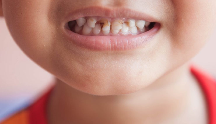 बच्चों के दांतों में लगा कीड़ा बन रहा परेशानी का कारण, इन आसान से उपायों से पाए छुटकारा