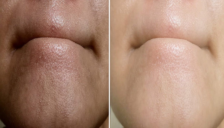 ब्लैकहैड बन रहा है बड़ी समस्या, ले इन ब्यूटी टिप्स की मदद