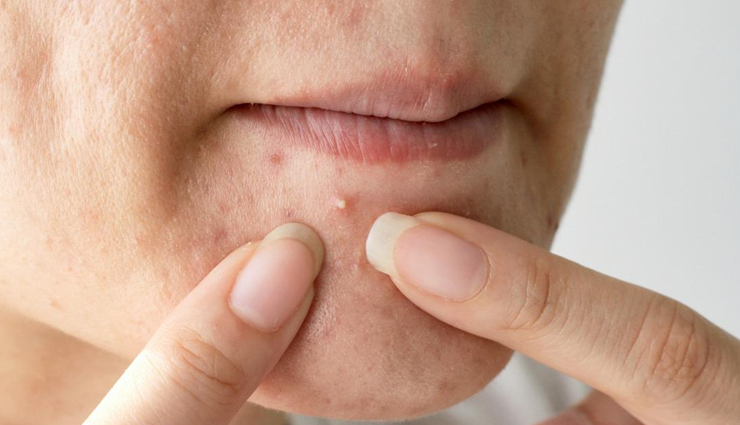 7 Remedies To Treat Acne and Blackhead on Chin Naturally