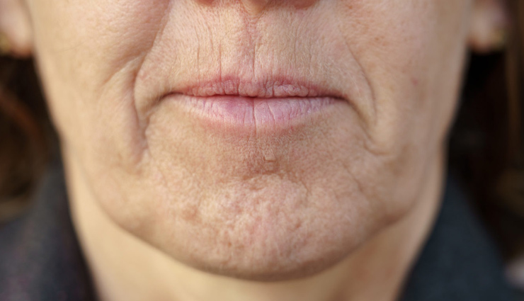 5 Home Remedies To Get Rid of Chin Hair