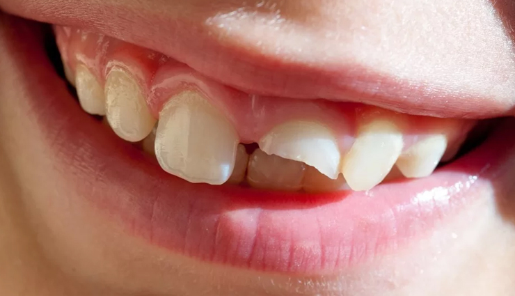 common mouth problems,tongue issues,dental hygiene,oral health concerns,mouth and tongue conditions,dental caries prevention,periodontal disease prevention,amalgam tattoo,halitosis treatment,black hairy tongue causes,canker sore remedies,tooth decay prevention,tooth abscess treatment,cold sore management,chipped tooth repair,leukoplakia diagnosis,lichen planus symptoms,thrush treatment,oral cancer detection,dry mouth remedies