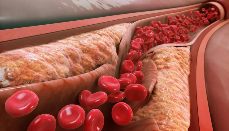 cholesterol,cholesterol level in body,cholesterol level check,cholesterol level in men,cholesterol level in women,health news,healthy living,Health tips