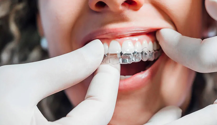 8 Well Known Facts About Clear Aligners for Your Teeth