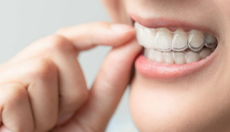 clear aligners facts,dental facts about clear aligners,clear aligners information,facts on teeth alignment,benefits of clear aligners,understanding clear aligners,clear aligners for dental correction,key points about clear aligners,clear aligners for teeth straightening,insights on clear aligners for oral care,teeth straightening with clear aligners,clear aligners versus traditional braces,clear aligners for orthodontic correction,advantages of using clear aligners,clear aligners for dental realignment,clear aligners for a perfect smile,dental health with clear aligners,invisible braces for teeth alignment,clear aligners benefits and drawbacks,clear aligners technology in dentistry