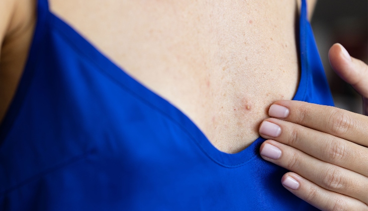 7 DIY Ways To Treat Cleavage Acne