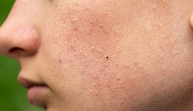 skin pcommon skin problems home remedies,home remedies for skin issues,most common skin problems,natural solutions for skin problems,home remedies for acne,home remedies for eczema,treating skin problems at home,diy skin treatments,natural skin care tips,common skin conditions home remediesroblems