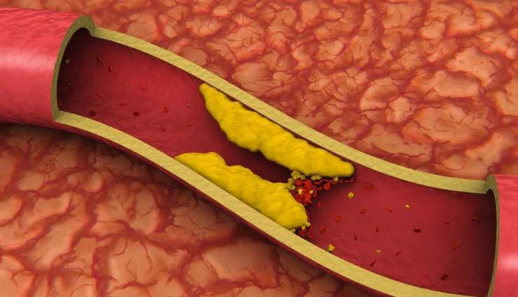 5 Alarming Symptoms of Clogged Arteries