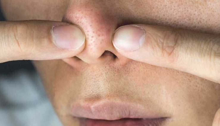 6 Home Remedies To Help You Get Rid of Clogged Pores