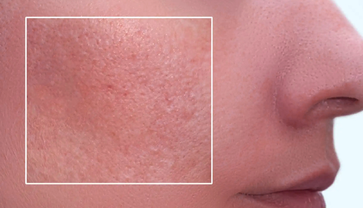 diy acne treatments,monsoon acne remedies,home remedies for acne,treat acne breakouts in monsoon,diy skincare for acne,acne treatment tips,monsoon skincare tips,natural acne solutions,tea tree oil for acne,aloe vera for acne,acne prevention in monsoon,neem for clear skin,turmeric for acne,oatmeal mask for acne,apple cider vinegar acne treatment