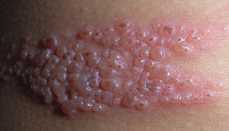 fungal acne explanation,understanding fungal acne,causes of fungal acne,symptoms of fungal acne,fungal acne treatments,fungal acne overview,fungal acne causes and remedies,how to treat fungal acne,fungal acne skin issues,fungal acne management