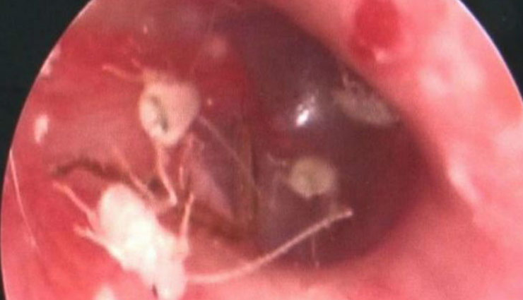 10 कॉकरोच का घर था इस युवक का कान, देख डॉक्टर के उड़ें होश