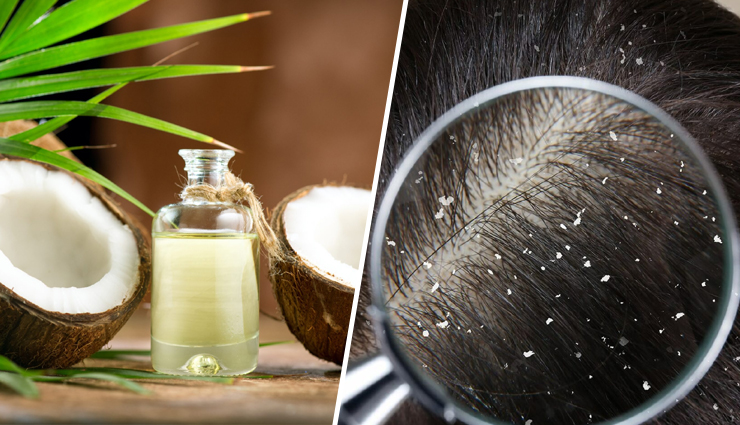 8 Homemade Coconut Oil Hair Masks for Common Dandruff Problems