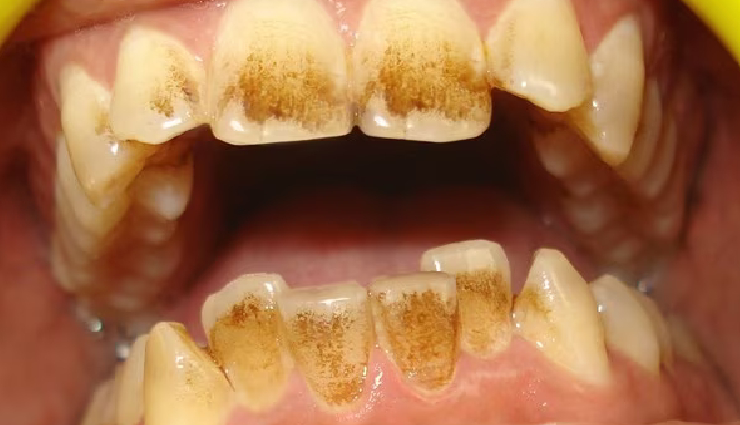 5 Home Remedies To Get Rid of Coffee Stains on Teeth