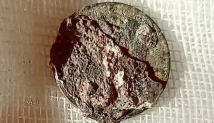 53 साल बाद शख्स की नाक से निकला सिक्का, डॉक्टर भी रह गए हैरान