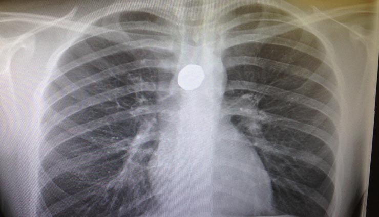 weird news,weird incident,coin in women throat,women get mute by coin