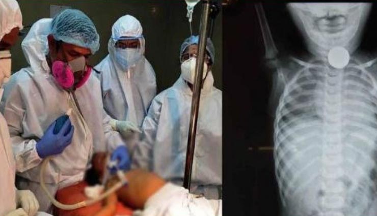 1 साल की बच्ची निगल गई 5 रुपए का सिक्का, जान बचाने के लिए डॉक्टर्स को उठाना पड़ा यह कदम