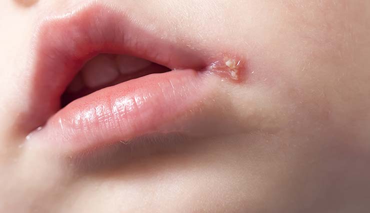 cold sores,home remedies for cold sores,home remedies,Health tips