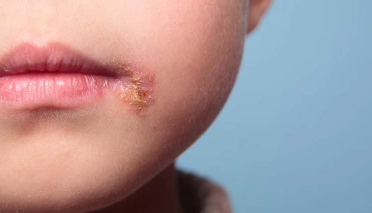 5 Natural Ways To Treat Cold Sores