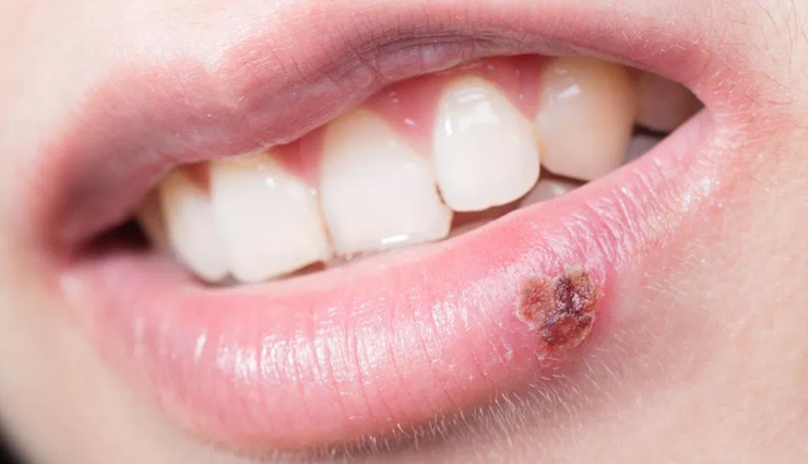 9 Remedies That are Effective To Treat Cold Sores