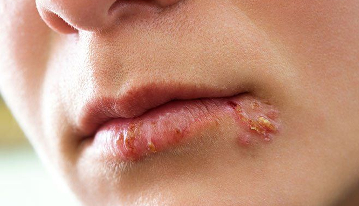 common mouth problems,tongue issues,dental hygiene,oral health concerns,mouth and tongue conditions,dental caries prevention,periodontal disease prevention,amalgam tattoo,halitosis treatment,black hairy tongue causes,canker sore remedies,tooth decay prevention,tooth abscess treatment,cold sore management,chipped tooth repair,leukoplakia diagnosis,lichen planus symptoms,thrush treatment,oral cancer detection,dry mouth remedies