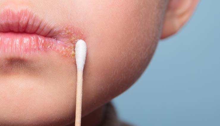cold sores,home remedies for cold sores,home remedies,Health tips