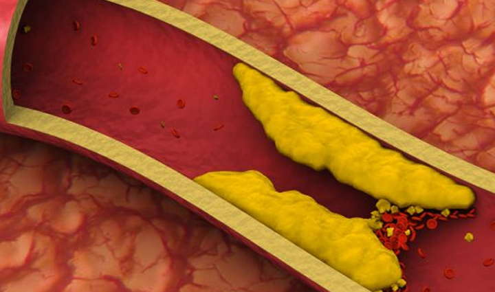 कोलेस्ट्रॉल बढ़ने पर बॉडी देने लगती हैं ये संकेत, जानें और समय पर हो जाएं सतर्क