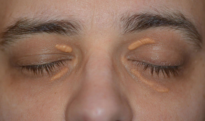 body starts giving these signs when cholesterol increases learn and be alert on time,Health,healthy living