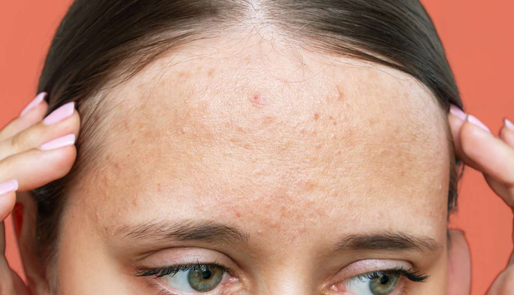 Comedonal Acne: Causes, How To Treat It, & Ways To Prevent It