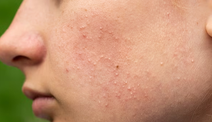 comedonal acne causes,treating comedonal acne,preventing comedonal acne,comedonal acne treatment options,how to manage comedonal acne,blackheads and whiteheads treatment,skincare for acne-prone skin,non-comedogenic skincare products,preventing clogged pores,healthy skincare practices