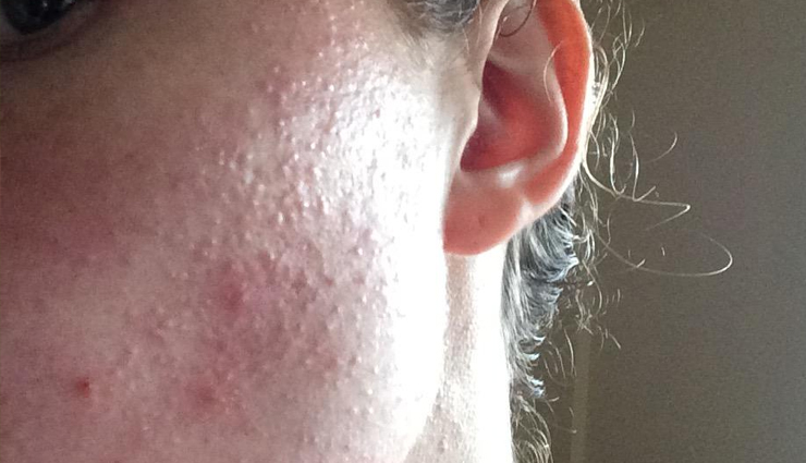 comedonal acne causes,treating comedonal acne,preventing comedonal acne,comedonal acne treatment options,how to manage comedonal acne,blackheads and whiteheads treatment,skincare for acne-prone skin,non-comedogenic skincare products,preventing clogged pores,healthy skincare practices