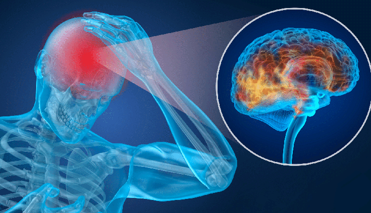 10 Effective Home Remedies to Treat Concussions