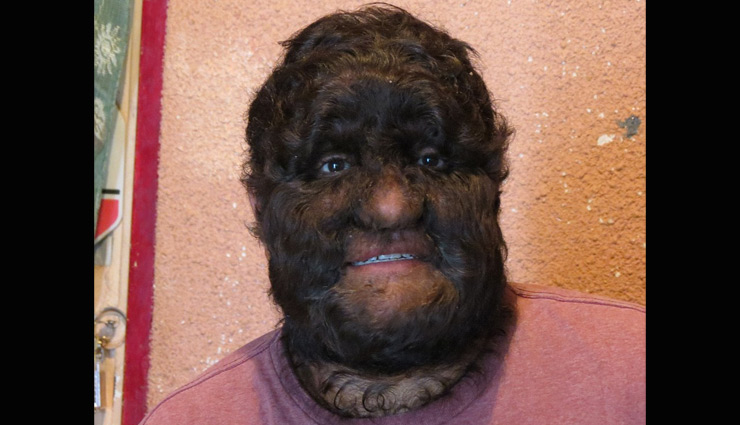 weird disease,hair grows all over body,congenital hypertrichosis