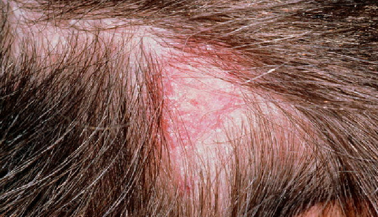 types of dandruff,dry scalp dandruff,oily scalp dandruff,fungal dandruff,psoriasis dandruff,seborrheic dermatitis,types of scalp conditions,dandruff causes,scalp health awareness,dandruff prevention tips