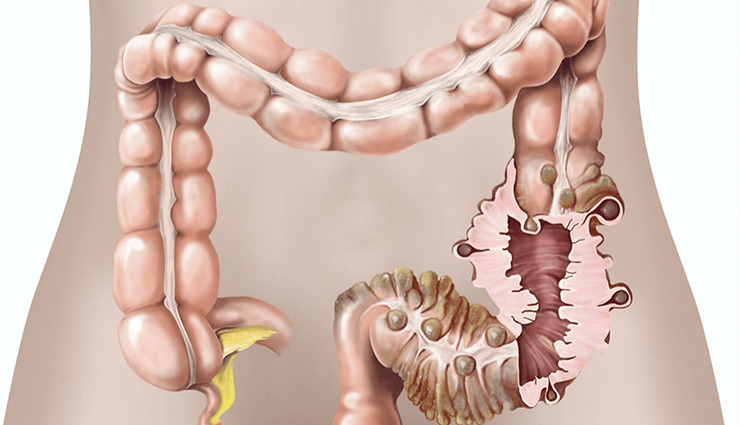 corn,health benefits of corn,Health tips,fitness tips