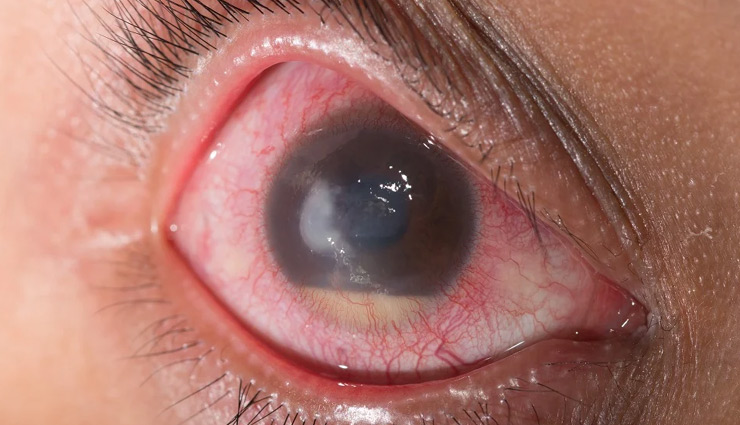 healthy living,Health,eyes,diabetes,cancer,eyes health,health news,healthy living