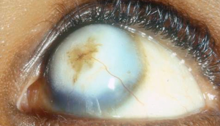 Health,healthy living,eyes,serious disease,Health tips