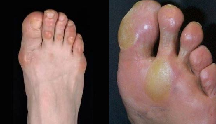 What Are Corns And Calluses, Major Symptoms, Causes and Treatment