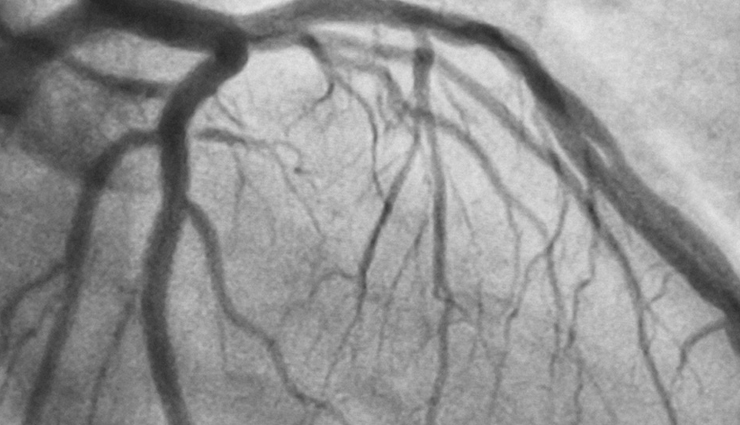 heart disease diagnosis tests,noninvasive cardiac tests,cardiovascular diagnostic procedures,diagnostic tests for heart conditions,heart health examinations,echocardiogram procedure,transesophageal echocardiography (tee),electrocardiogram (ecg or ekg) test,magnetic resonance imaging (mri) for heart,ct scan for cardiac evaluation,exercise cardiac stress test,pharmacologic stress test,tilt test for fainting,ambulatory rhythm monitoring,holter monitoring,event recorders,mobile cardiac telemetry (mct),coronary angiogram procedure,heart artery examination,coronary artery blockage detection