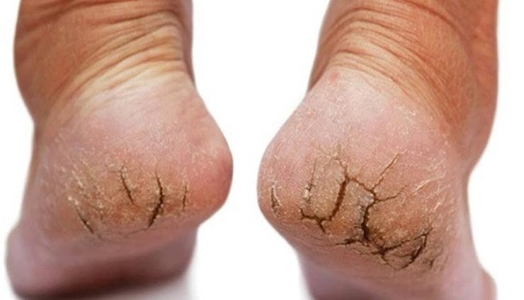 इन टिप्स की मदद से बनाए कटी-फटी एड़ियों को मुलायम, जल्द दिखेगा असर