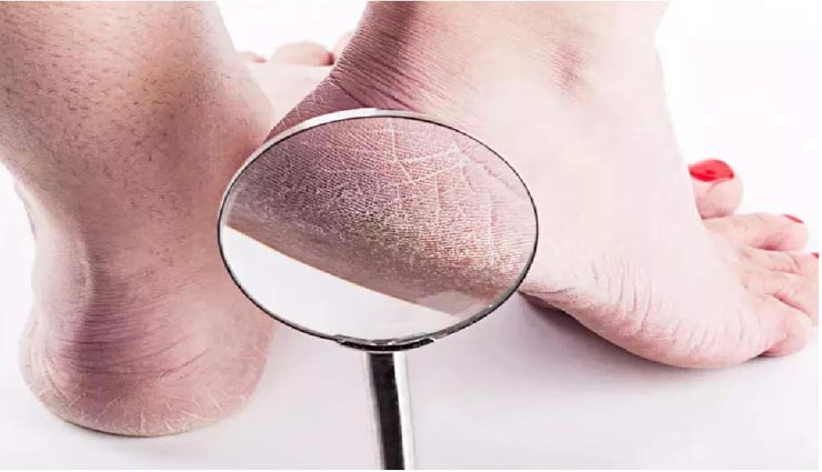 मिनटों में मुलायम होगी फटी एडियां, आजमाए ये देसी नुस्खे