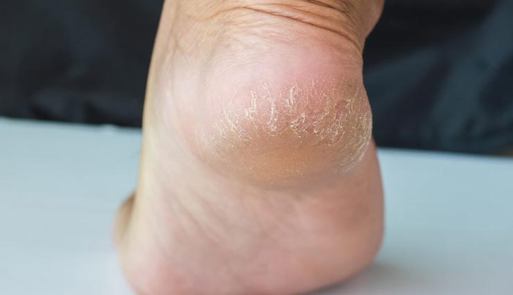 सर्दियों में बढ़ने लगती हैं फटी एडियों की समस्या, इन घरेलू नुस्खों से बनाए इन्हें कोमल 