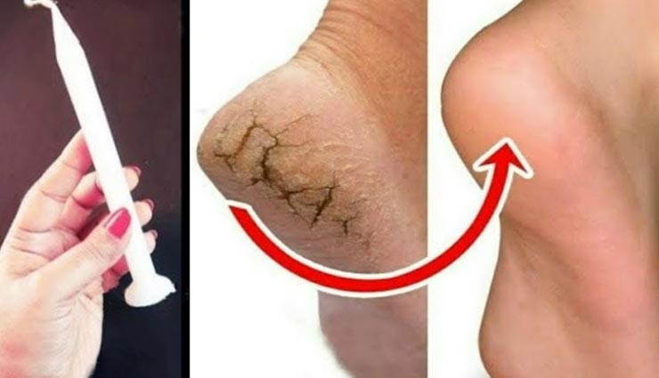 beauty tips,beauty tips in hindi,crack heels,home remedies,legs beauty