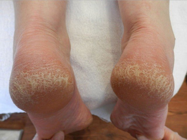 home remedies,remedies for cracked heels,skin care tips