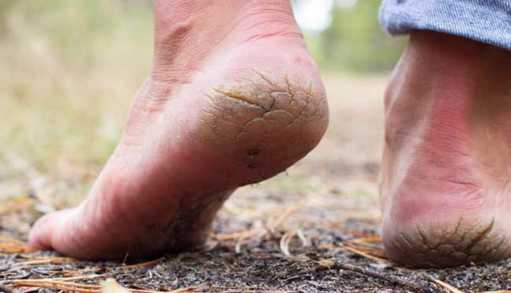 cracked heels,remedies for cracked heels,heels care tips,beauty tips,legs care tips,skin care tips