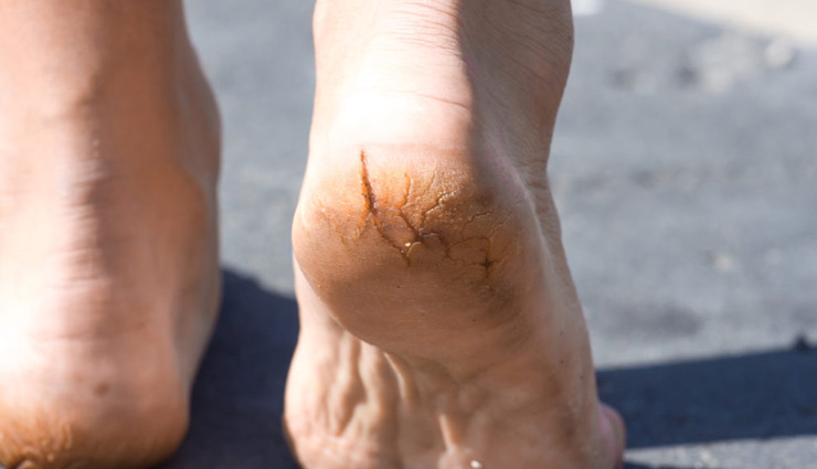 5 Remedies To Treat Cracked Heels During Winters