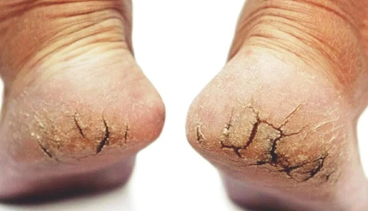 इस तरह रखें अपनी एड़ियों को सुरक्षित, बचाए इन्हें फटने से