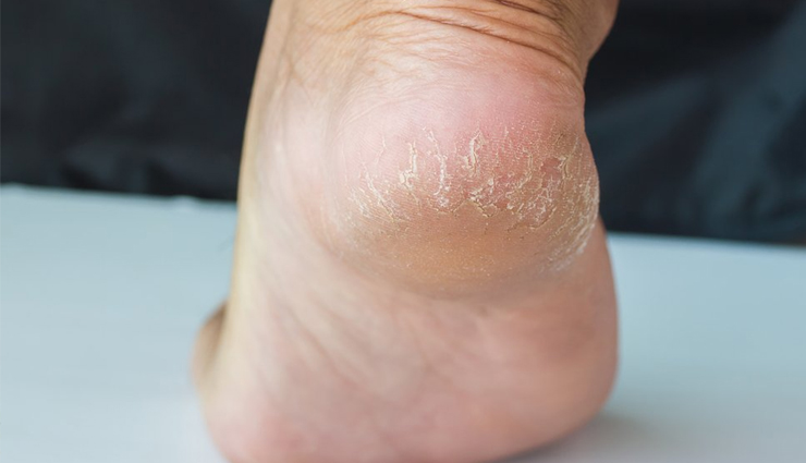 5 Home Remedies to Help You Get Crack Free Heels