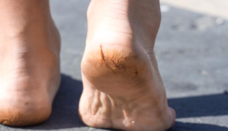 ये घरेलू उपाय दिलाएंगे फटी एड़ियों में राहत, जानें और आजमाए