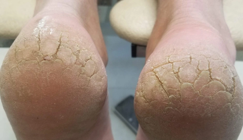 6 DIY Ways To Treat Cracked Heels